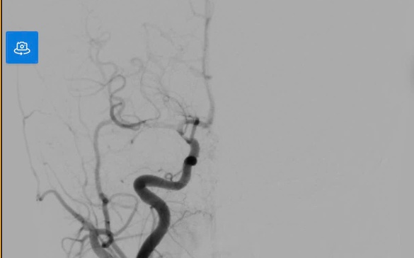 Cảnh báo đột quỵ não ở trẻ: Ca bệnh đánh thức sự chủ quan