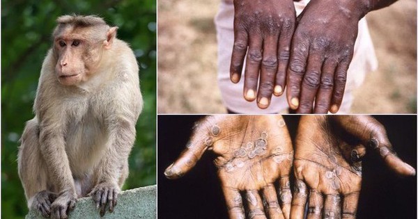 Bệnh đậu mùa khỉ có thể bị tái phát không?
